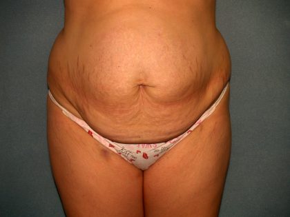 Tummy Tuck Before & After Patient #2005