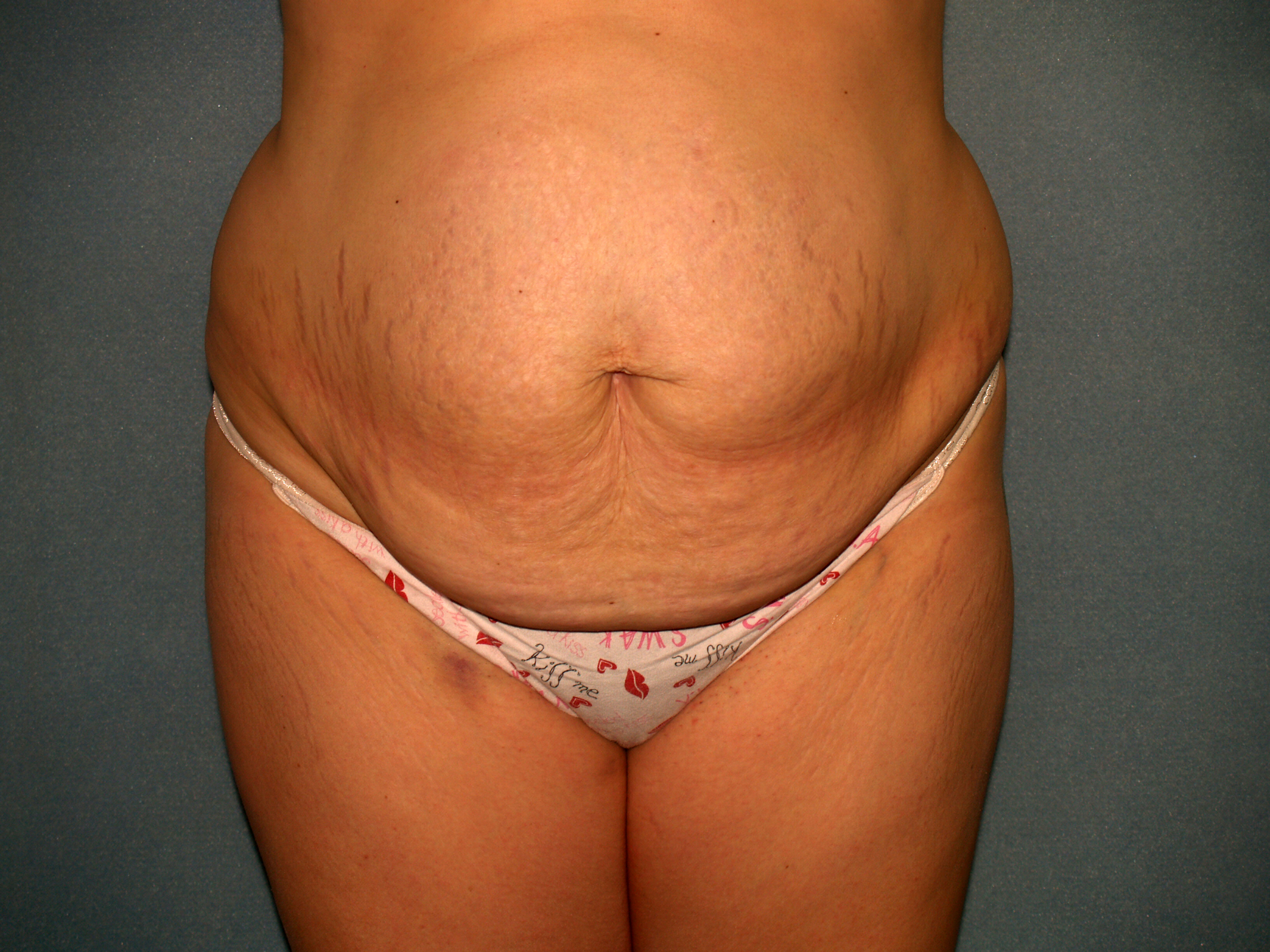 Tummy Tuck Before & After Patient #2005