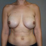 Breast Reconstruction Before & After Patient #1862