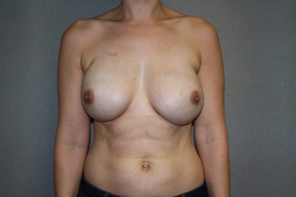 Breast Reconstruction Before & After Patient #1862
