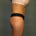 Tummy Tuck Before & After Patient #2377
