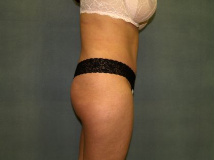 Tummy Tuck Before & After Patient #2377