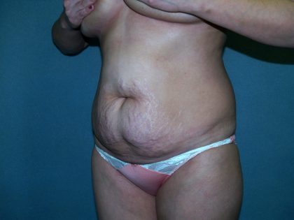 Tummy Tuck Before & After Patient #2377