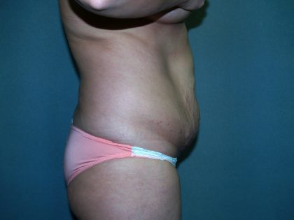 Tummy Tuck Before & After Patient #2377