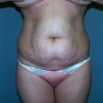 Tummy Tuck Before & After Patient #2377