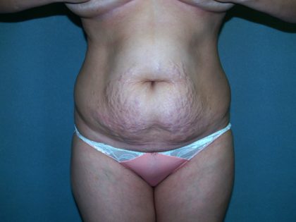 Tummy Tuck Before & After Patient #2377