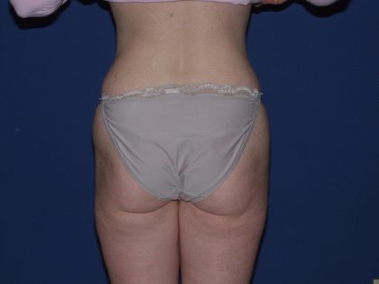 Tummy Tuck Before & After Patient #3549