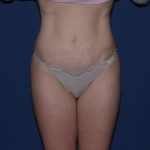 Tummy Tuck Before & After Patient #3549