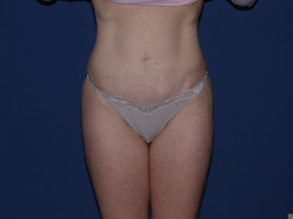 Tummy Tuck Before & After Patient #3549