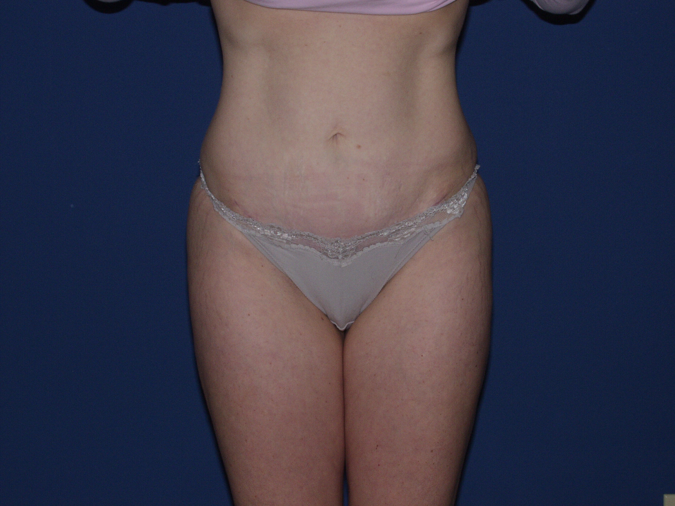 Tummy Tuck Before & After Patient #3549