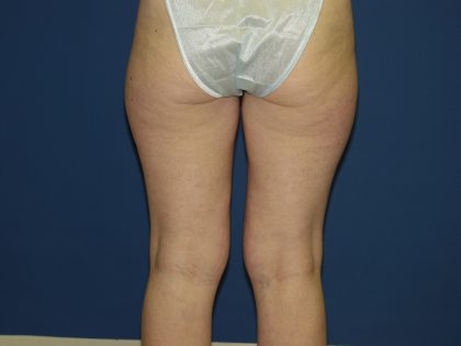 Tummy Tuck Before & After Patient #3549