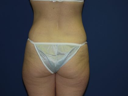 Tummy Tuck Before & After Patient #3549