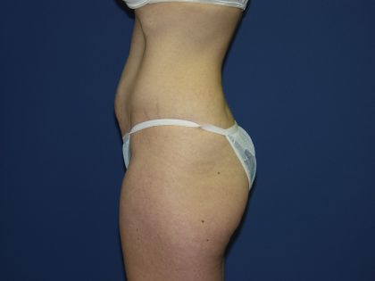 Tummy Tuck Before & After Patient #3549