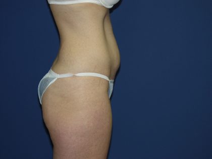 Tummy Tuck Before & After Patient #3549