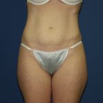 Tummy Tuck Before & After Patient #3549