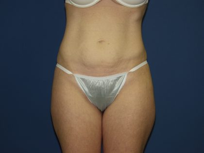 Tummy Tuck Before & After Patient #3549