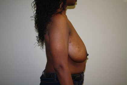 Breast Reconstruction Before & After Patient #1790