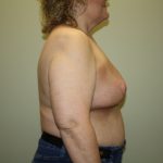 Breast Reconstruction Before & After Patient #2297