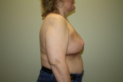 Breast Reconstruction Before & After Patient #2297