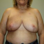 Breast Reconstruction Before & After Patient #2297