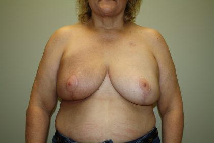 Breast Reconstruction Before & After Patient #2297