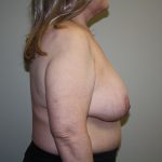 Breast Reconstruction Before & After Patient #2297