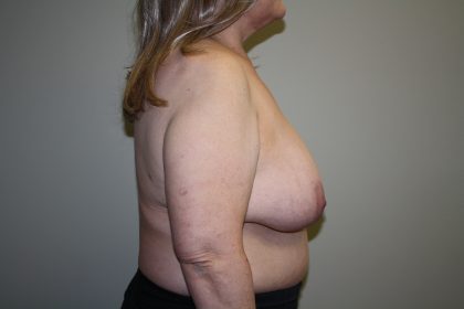 Breast Reconstruction Before & After Patient #2297