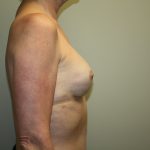 Breast Reconstruction Before & After Patient #1941