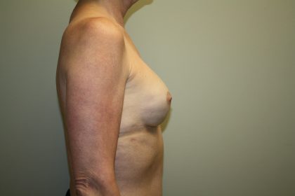 Breast Reconstruction Before & After Patient #1941