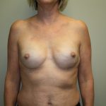 Breast Reconstruction Before & After Patient #1941