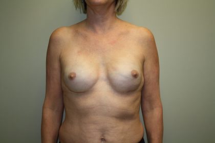 Breast Reconstruction Before & After Patient #1941