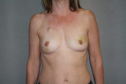 Breast Reconstruction Before & After Patient #1941