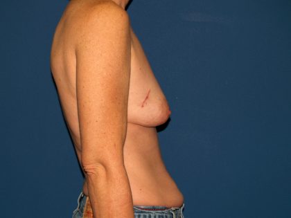 Breast Reconstruction Before & After Patient #2130