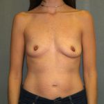 Breast Augmentation Before & After Patient #2647