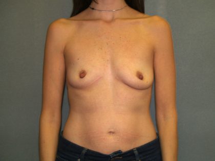 Breast Augmentation Before & After Patient #2647