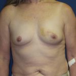 Breast Reconstruction Before & After Patient #1890