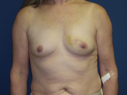 Breast Reconstruction Before & After Patient #1890