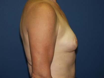 Breast Reconstruction Before & After Patient #1890