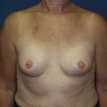 Breast Reconstruction Before & After Patient #1890