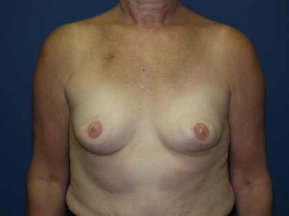 Breast Reconstruction Before & After Patient #1890