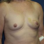 Breast Reconstruction Before & After Patient #1890