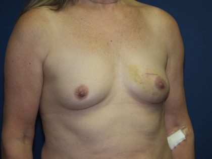 Breast Reconstruction Before & After Patient #1890