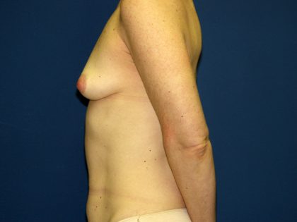 Breast Reconstruction Before & After Patient #1833