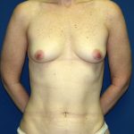 Breast Reconstruction Before & After Patient #1833