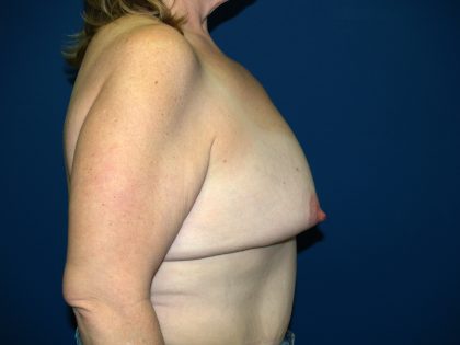 Breast Reconstruction Before & After Patient #1825