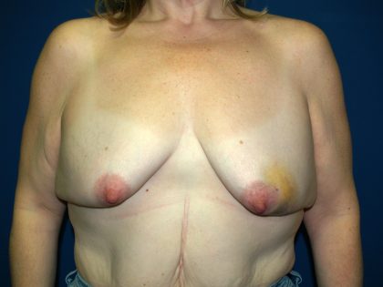 Breast Reconstruction Before & After Patient #1825