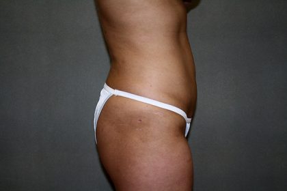 Liposuction Before & After Patient #3867