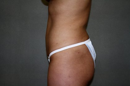 Liposuction Before & After Patient #3867