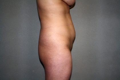 Liposuction Before & After Patient #3867