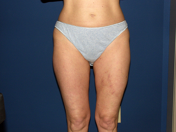 Liposuction Before & After Patient #3656